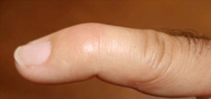 Mallet Finger.JPG