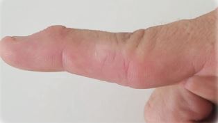 tendon management.JPG