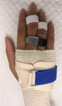 Metacarpal fracture brace.jpg