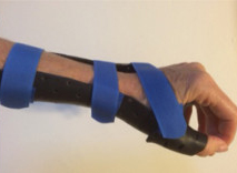 Long-Opponens-Thumb-Spica-Orthosis.jpg