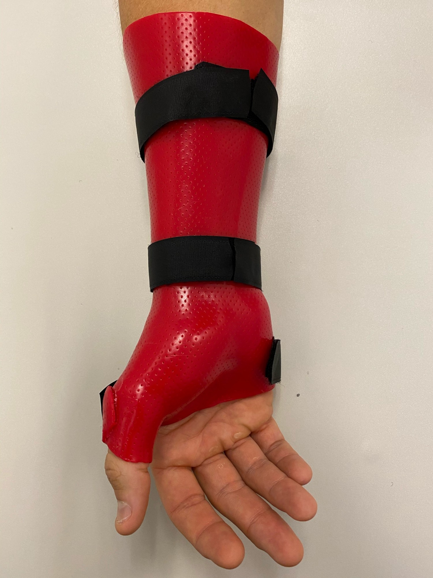 splint use for De Quervain's Tendinopathy De Quervain Tendinopathy
