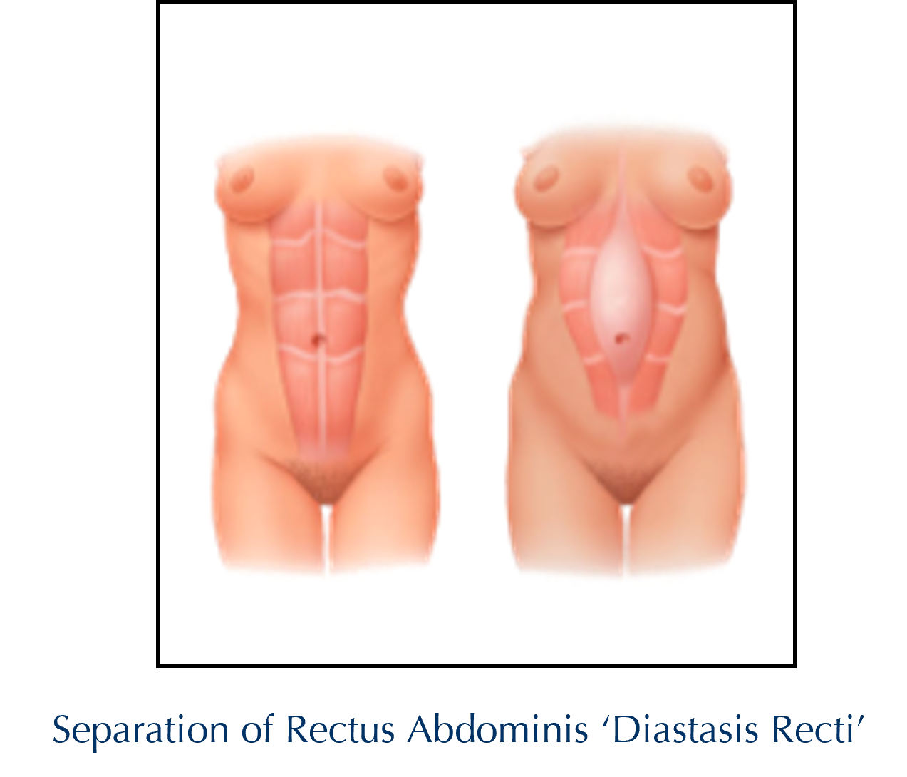 Diastasis Recti.png