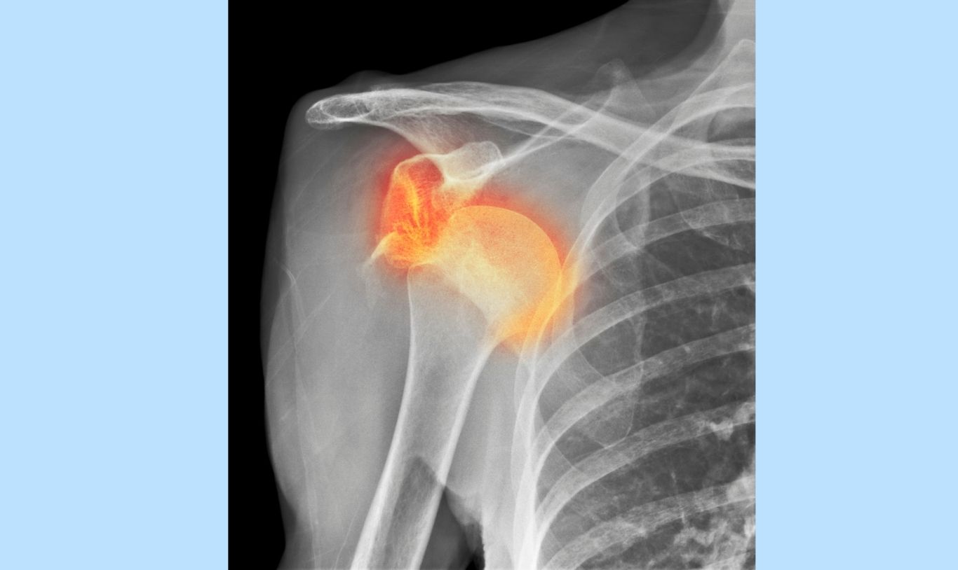 Dislocated Shoulders.jpg