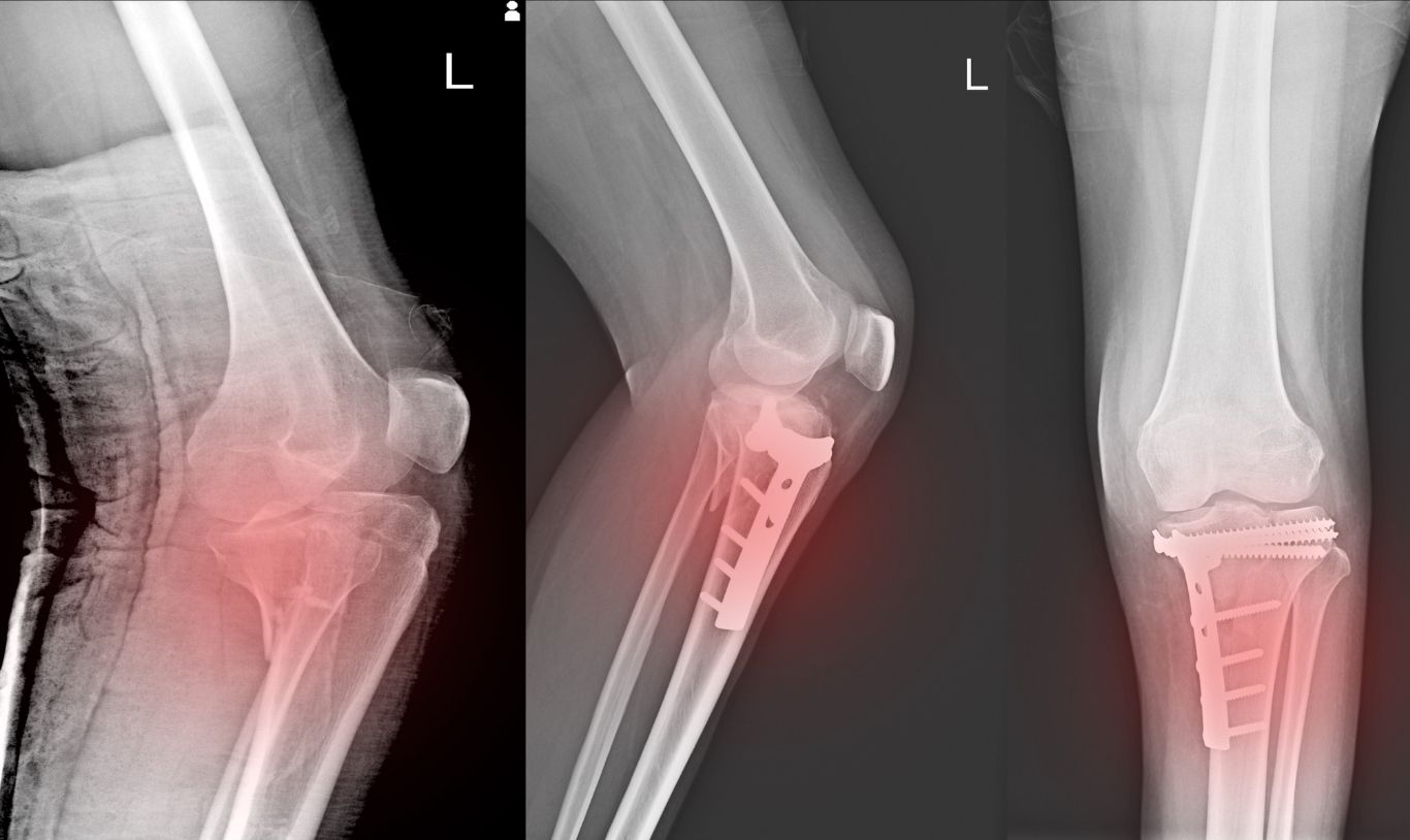 142- Fractures and sprain.jpg