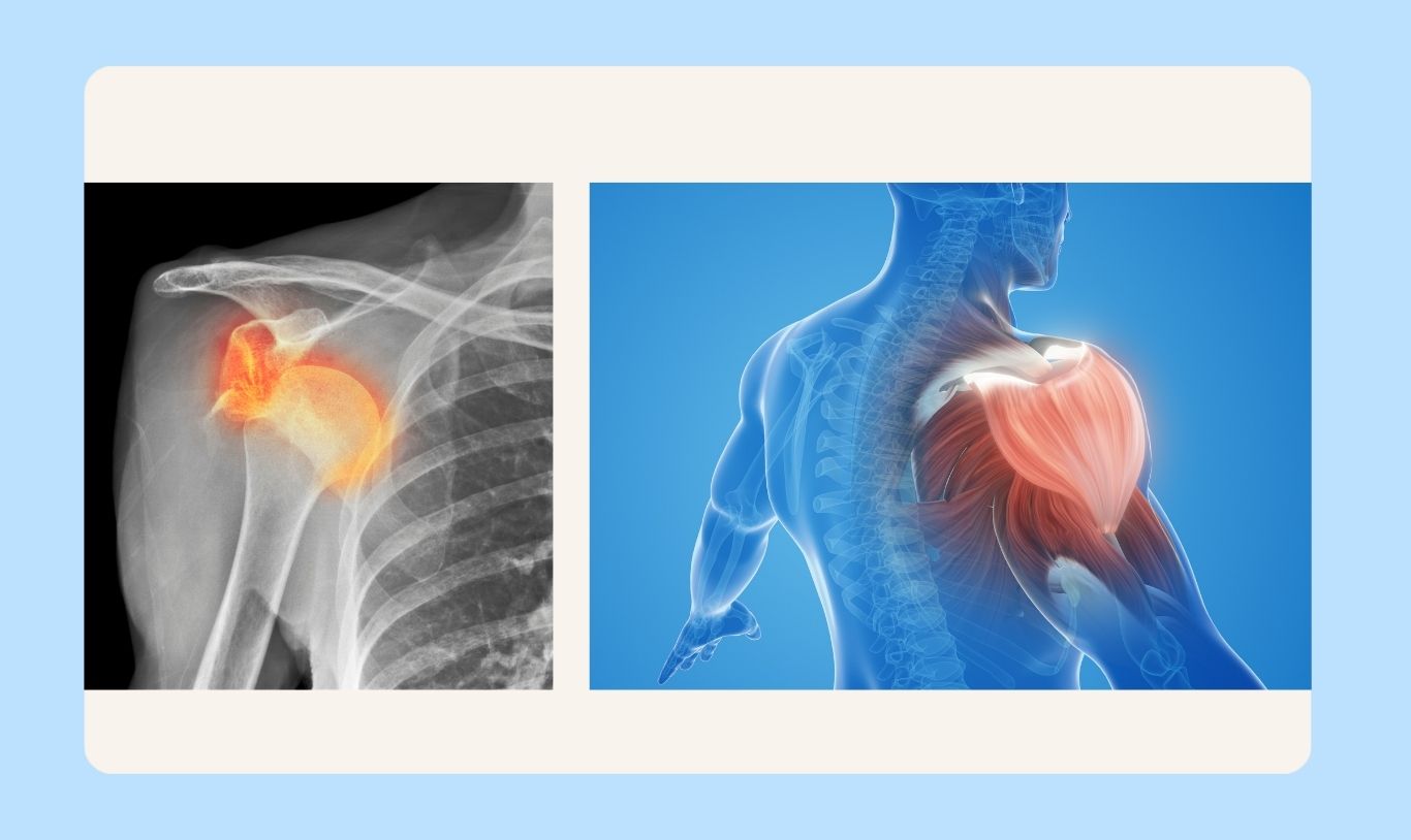 143-Shoulder Injuries.jpg